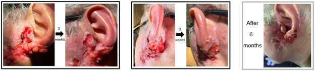 Cannot place electrodes on ear lobe